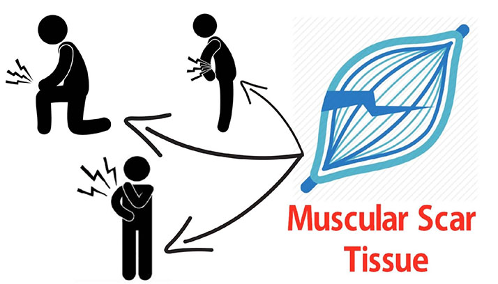 NUCCA Chiropractor Northbrook IL Muscular Scar Tissue